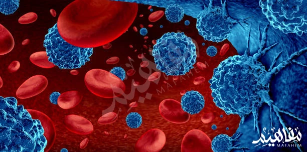 ورم نقوي متعدد ورم نقوي متعدد