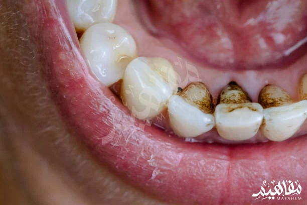 تسوس الاسنان تسوس الاسنان