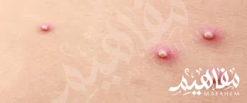 الحبوب ذات الرأس الأبيض