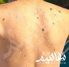 الحبوب ذات الرأس الأسود