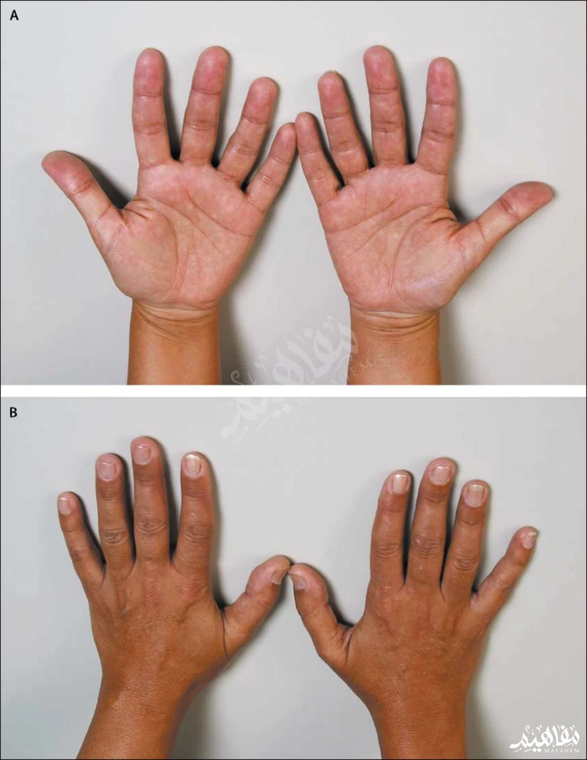 مرص أديسون مرص أديسون