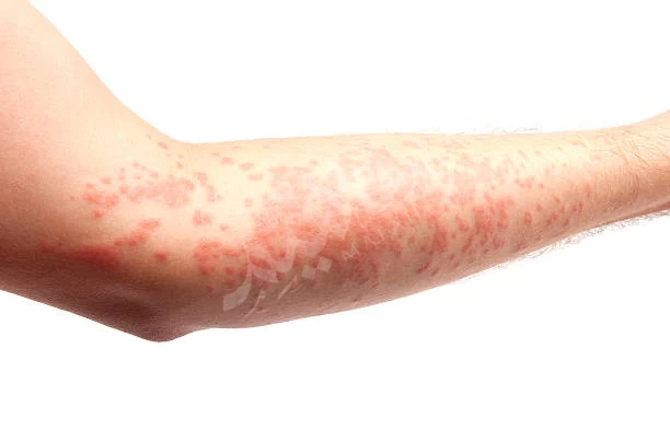 Histamine  Histamine