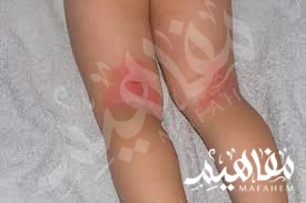 Skin fold fungi Skin fold fungi