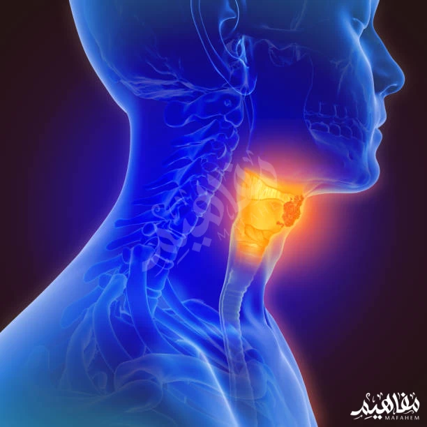 ورم الحلق ورم الحلق