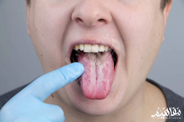 oral thrush oral thrush