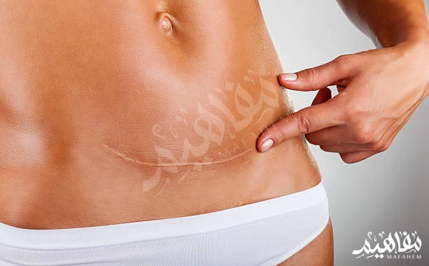 caesarean section caesarean section