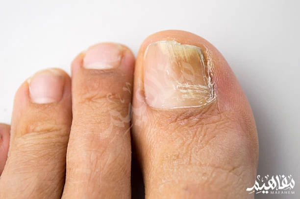 nail fungus nail fungus