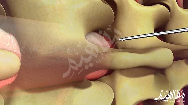 التخدير للولادة القيصرية