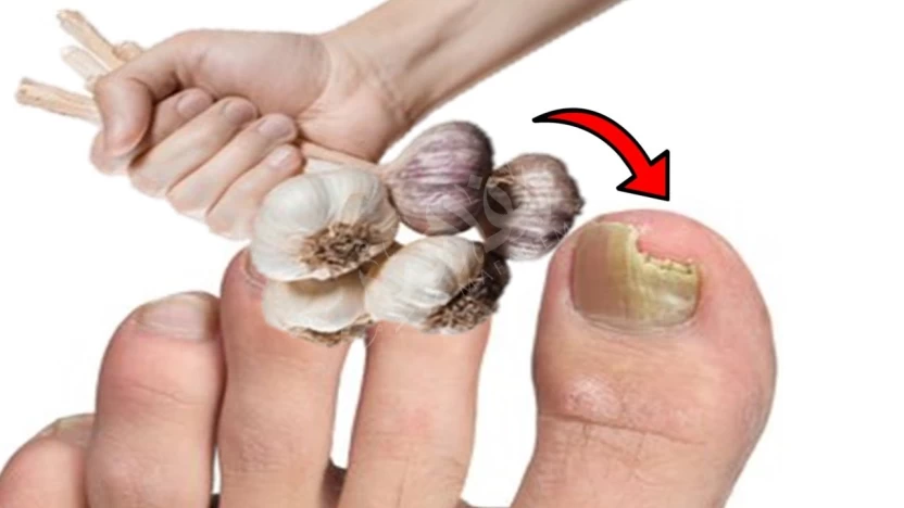 garlic for nail fungus garlic for nail fungus