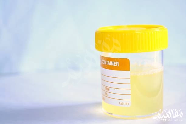 Persistent proteinuria Persistent proteinuria
