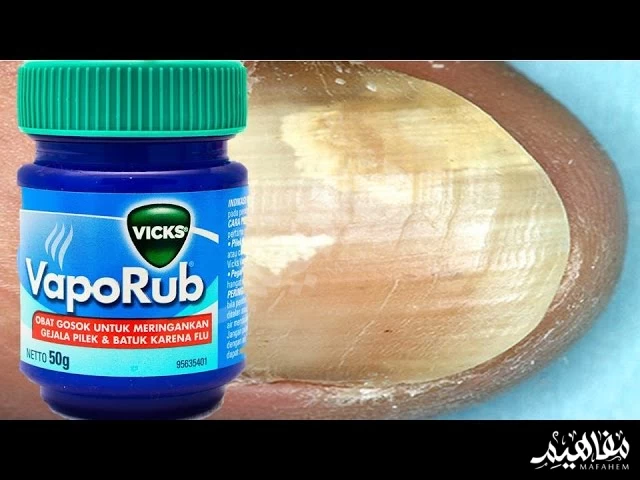 Fungal nail infection Fungal nail infection