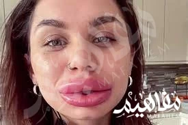 lips filler lips filler