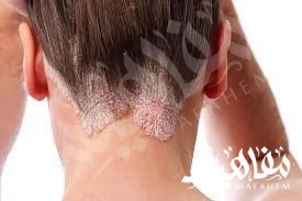 scalp fungus scalp fungus