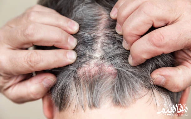 Scalp Psoriasis Scalp Psoriasis