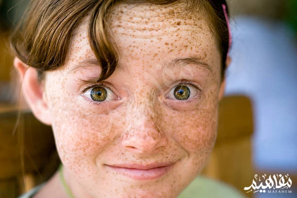 freckles freckles