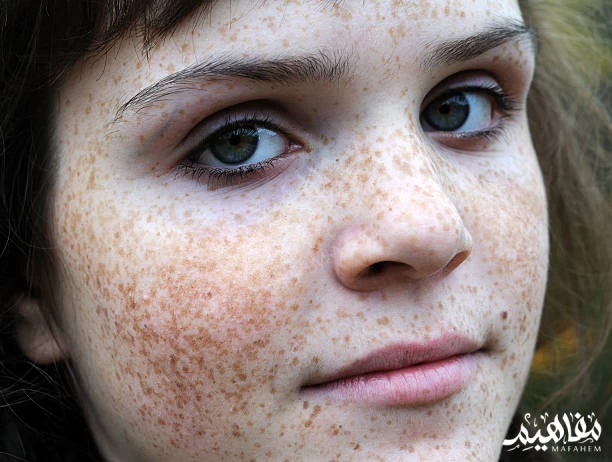 freckles freckles