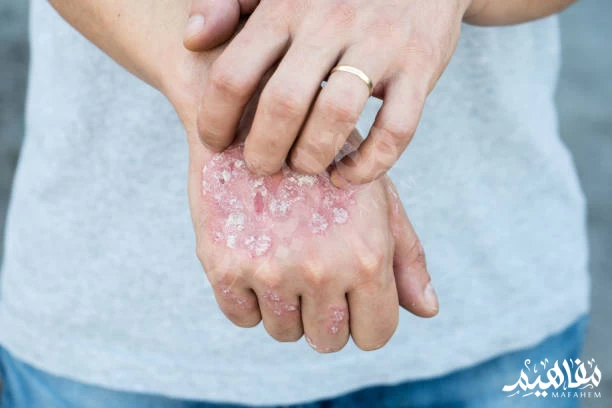 plaque psoriasis plaque psoriasis