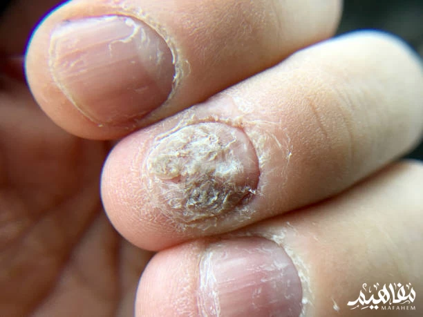 nail psoriasis nail psoriasis