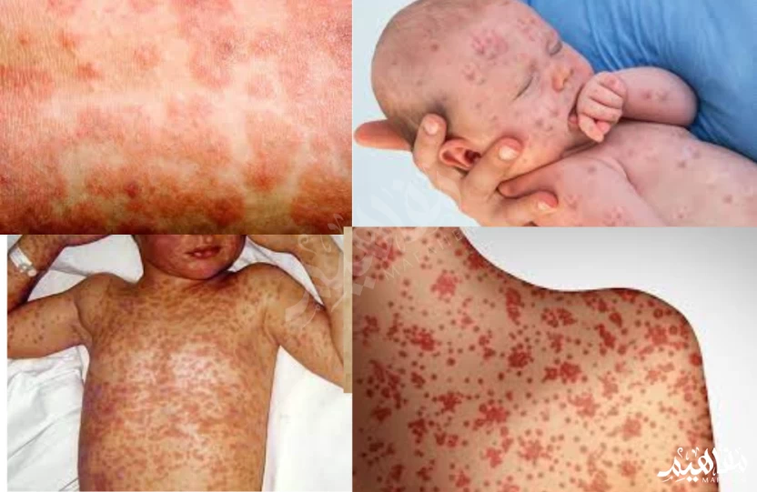 Measles Measles