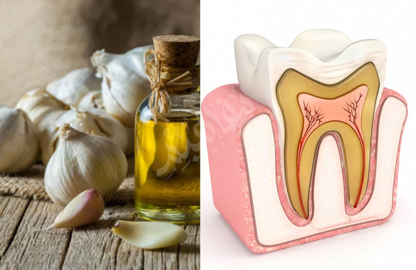 زيت الثوم لعلاج عصب الاسنان زيت الثوم لعلاج عصب الاسنان
