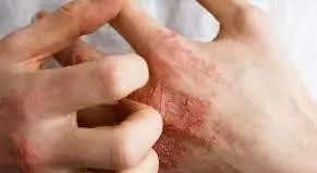 الحساسية-العصبية الحساسية-العصبية