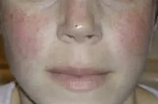 الحساسية-الضوئية الحساسية-الضوئية