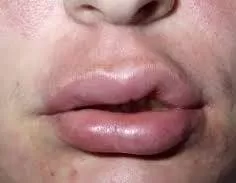 الوذمة-الوعائية الوذمة-الوعائية