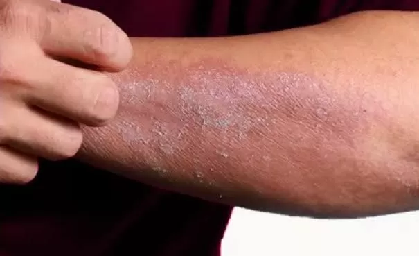 التهاب-الجلد-التماسي التهاب-الجلد-التماسي