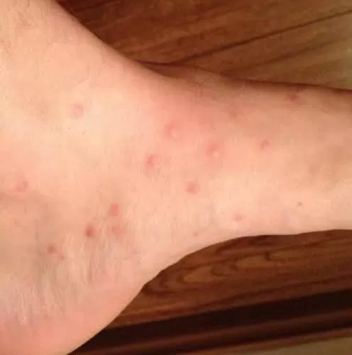 لسعات-البراغيث لسعات-البراغيث