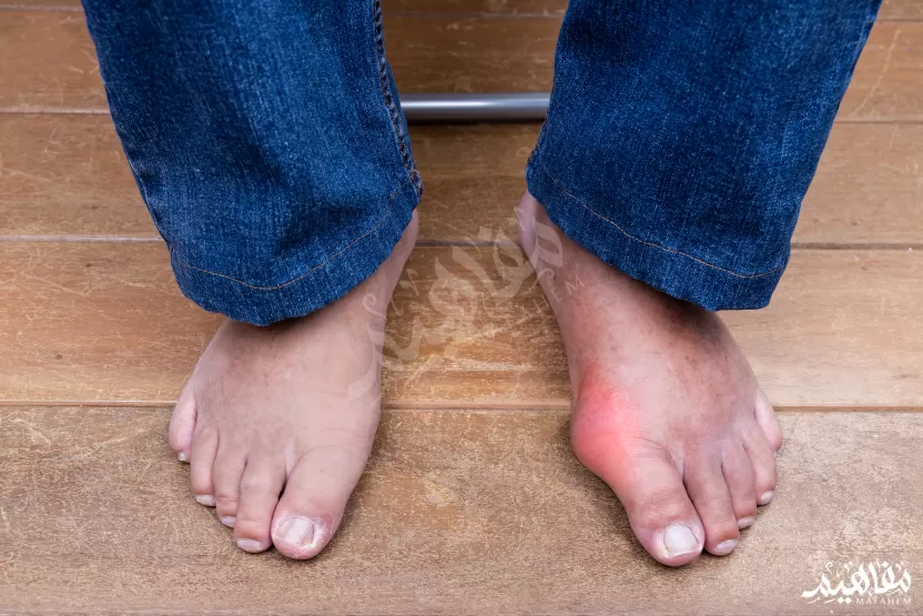 آلام_النقرس آلام_النقرس