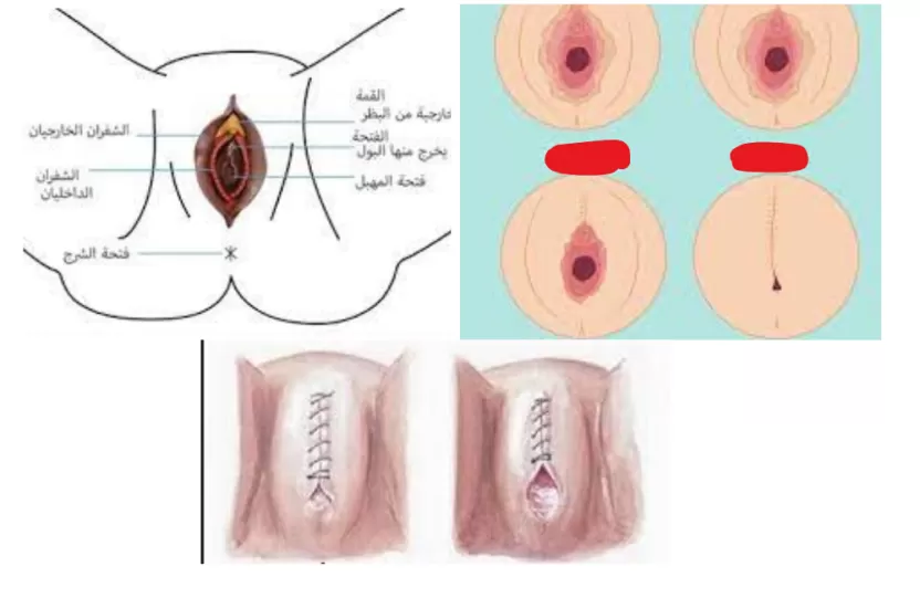 شكل البنت قبل وبعد الختان شكل البنت قبل وبعد الختان