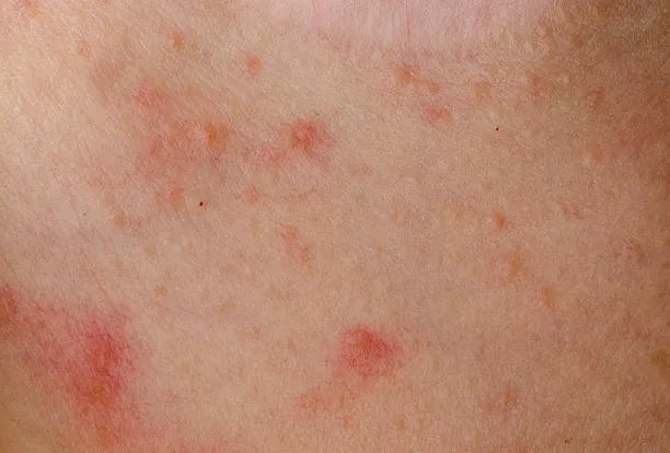 دمامل الغدد العرقية