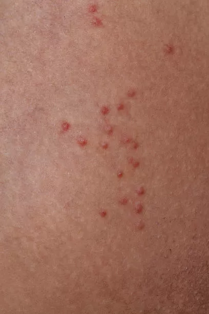 دمامل الجمرات