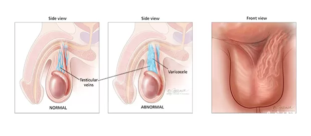 دوالي الخصية الثانوية دوالي الخصية الثانوية
