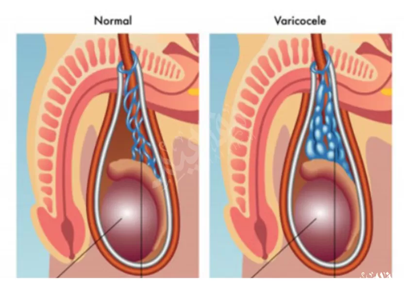 دوالي الخصية الأولية دوالي الخصية الأولية