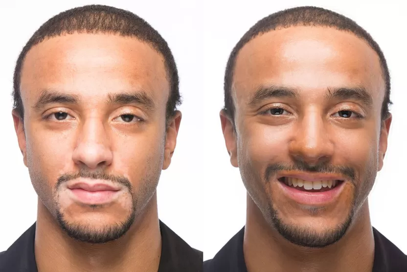 بداية البهاق بالصور