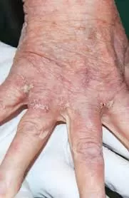 شكل الجرب القشري شكل الجرب القشري