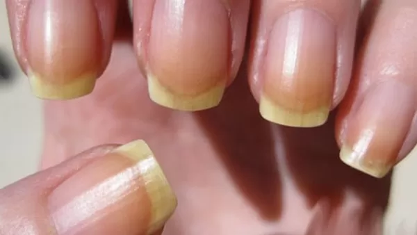 الأظافر الصفراء الأظافر الصفراء
