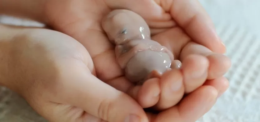 شكل_قطع_الاجهاض_في_الشهر_الثاني شكل_قطع_الاجهاض_في_الشهر_الثاني