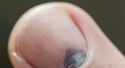 الأظافر السوداء الأظافر السوداء