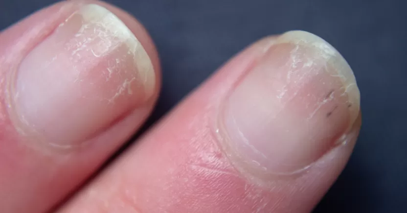 تشقق الأظافر تشقق الأظافر