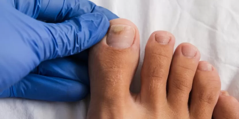 انفصال الأظافر انفصال الأظافر