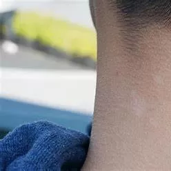 فطريات الجلد البيضاء فطريات الجلد البيضاء