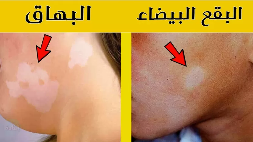 الفرق بين البهاق والبقع البيضاء الفرق بين البهاق والبقع البيضاء