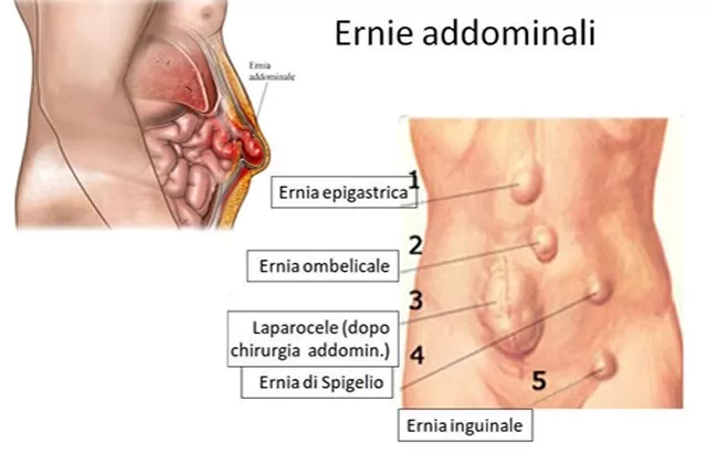 Hernia in men Hernia in men