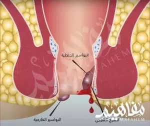 صورة الفرق بين الناسور والبواسير صورة الفرق بين الناسور والبواسير