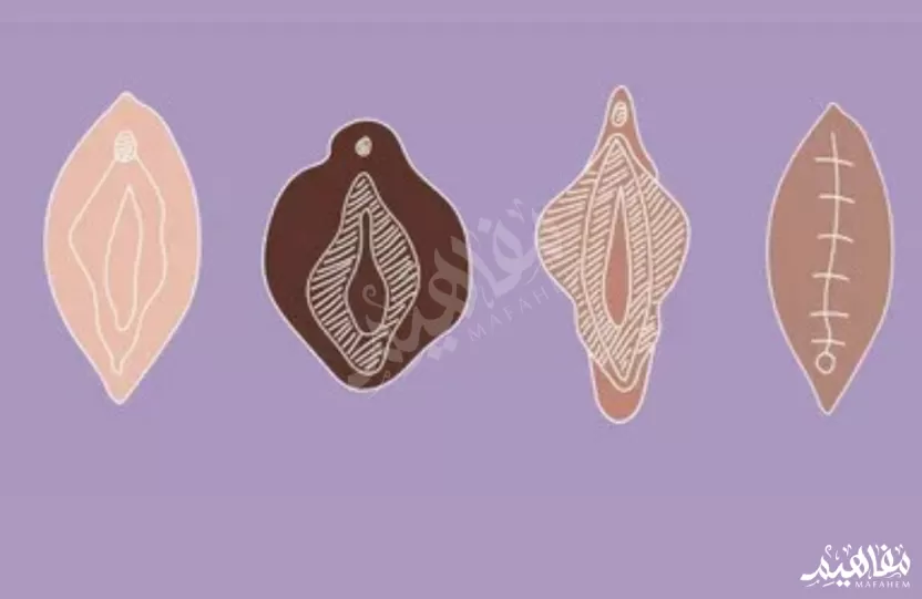 شكل_الختان_الفرعوني شكل_الختان_الفرعوني