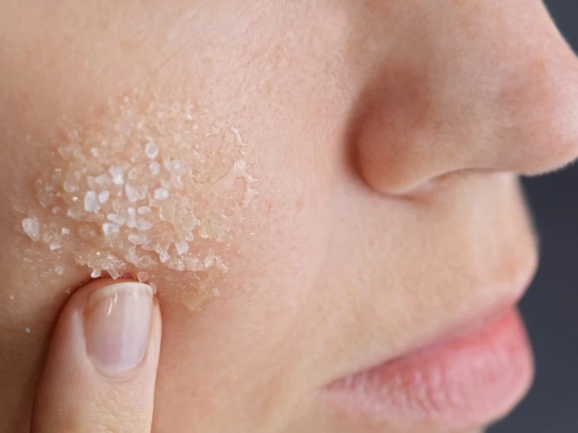 تصغير المسامات