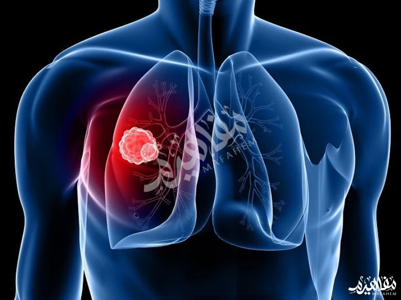 سرطان الرئة سرطان الرئة
