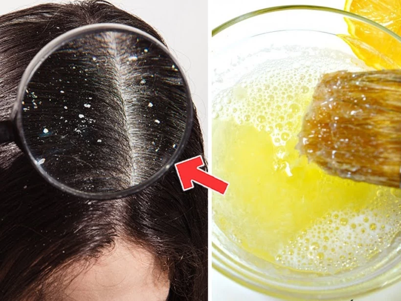 علاج-القشرة-الشعر علاج-القشرة-الشعر